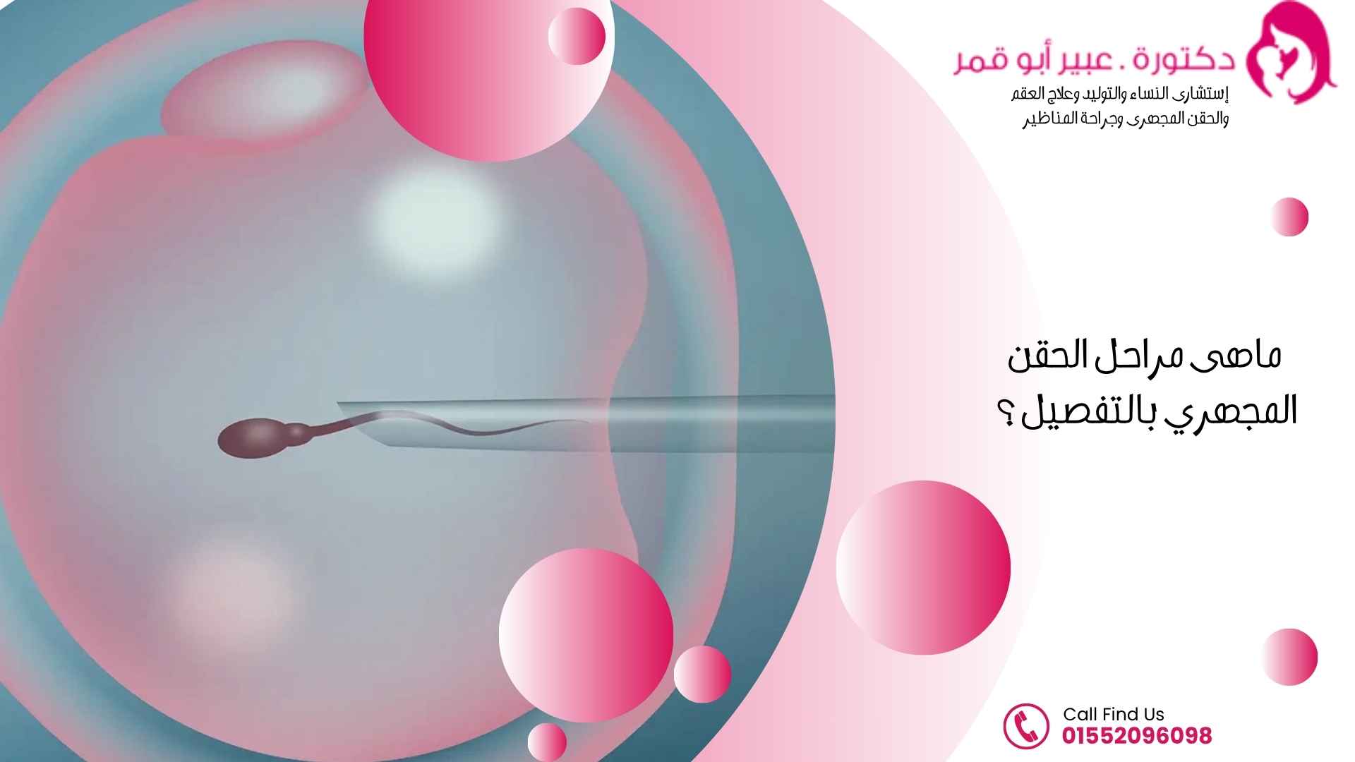 ماهى-مراحل-الحقن-المجهري-بالتفصيل